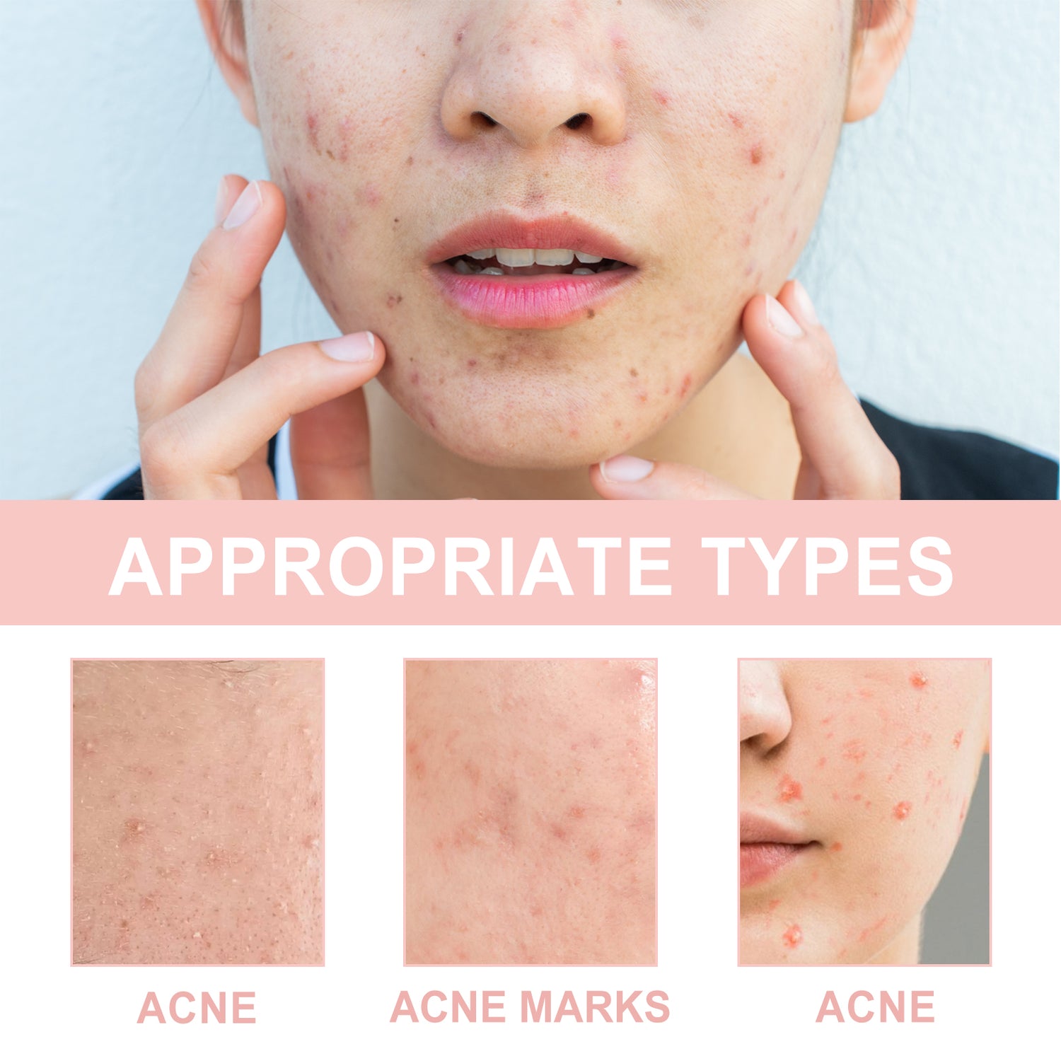OUHOE Acne Repair &amp; Pore Cleansing Patch